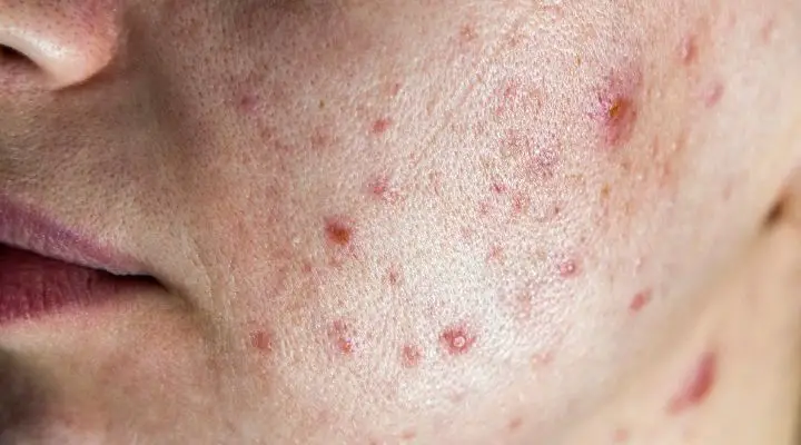 What Do These Red Dots On Your Skin Mean?