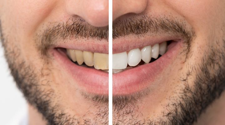 Guaranteed! Whiten your yellow teeth in less than 2 minutes!