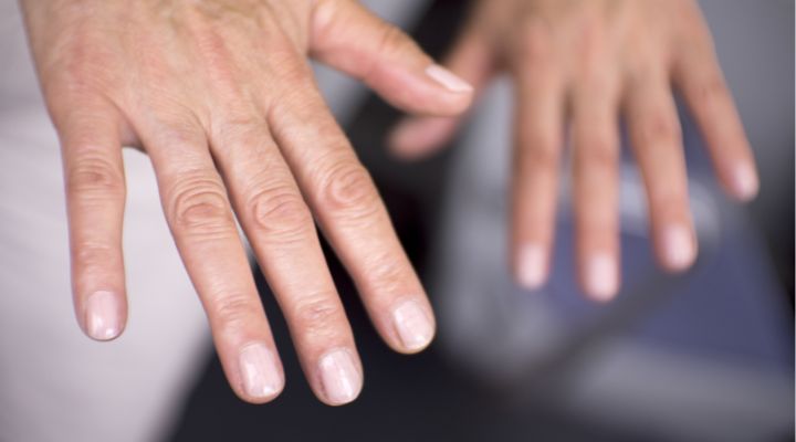Early Warning Signs of LUPUS